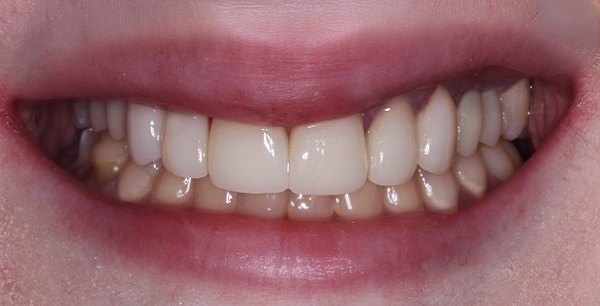 Porcelain veneers & crowns for upper arch rehabilitation.