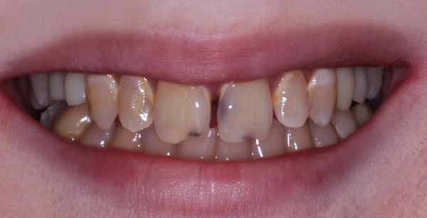 Porcelain veneers & crowns for upper arch rehabilitation.