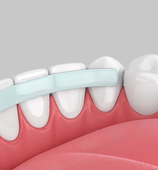 Fix Chips, Cracks & Gaps in Just One Visit