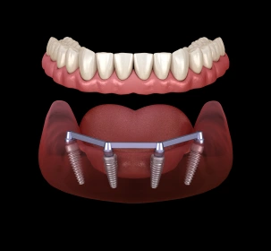 Implant Dentures (All-on-4 or Snap-On)