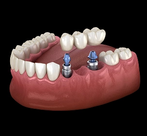 Implant-Supported Bridge