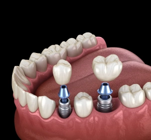 Multiple Tooth Implants