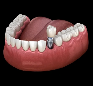 Single Tooth Implant