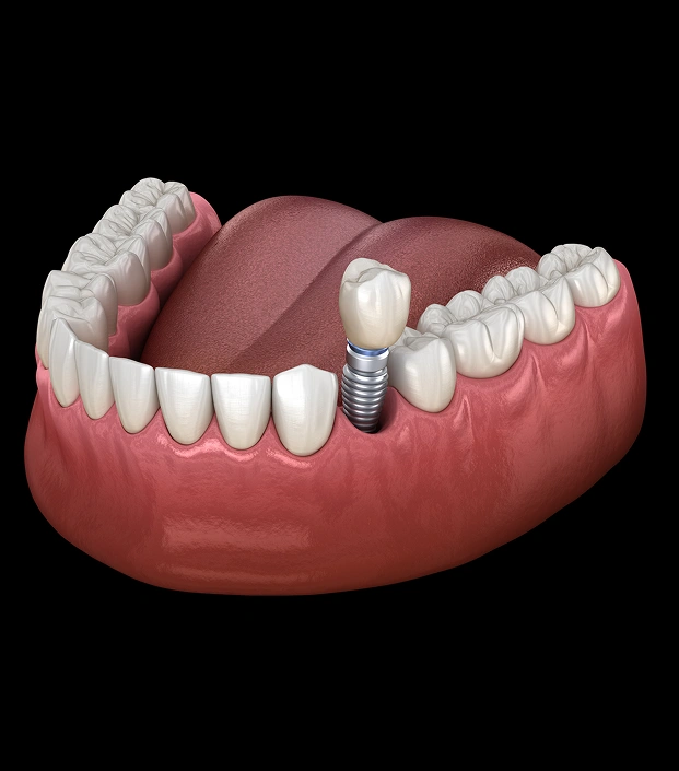 Permanent Solutions for Missing Teeth