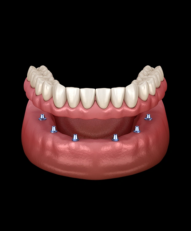 Say Goodbye to Loose Dentures