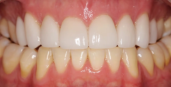 Eight upper veneers to fix bite and improve aesthetics.