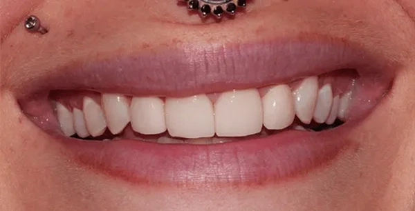 Four front porcelain veneers to improve aesthetics.