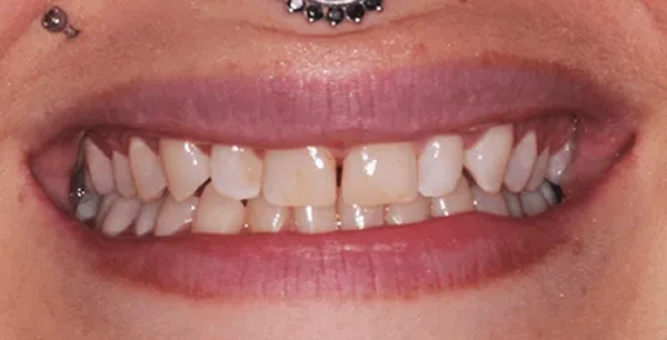 Four front porcelain veneers to improve aesthetics.