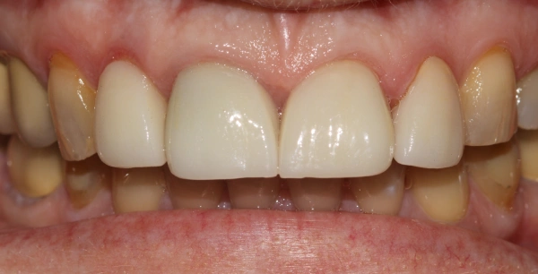 Four new crowns.