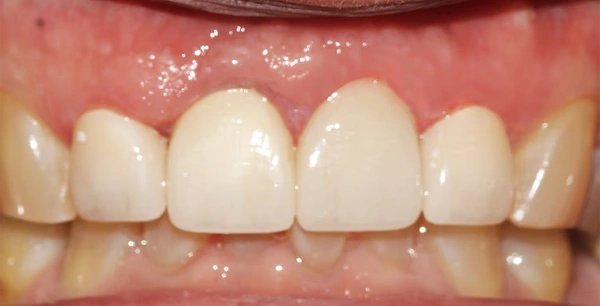 Four new crowns and gum therapy to improve aesthetics.