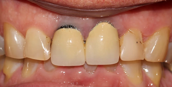 Four new crowns and gum therapy to improve aesthetics.