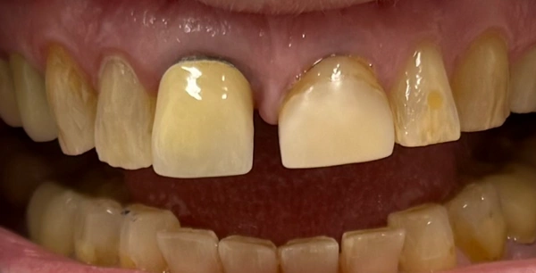 Four new crowns.