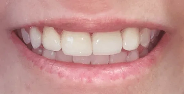 Four front porcelain veneers to improve aesthetics.