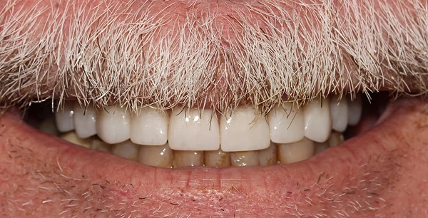Porcelain veneers & crowns for upper arch rehabilitation.