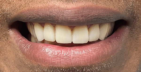 Six veneers to fix spacing and improve aesthetics.