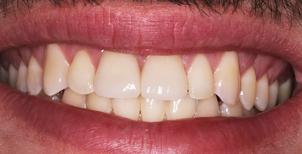 Two porcelain crowns after trauma.