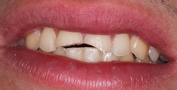 Two porcelain crowns after trauma.